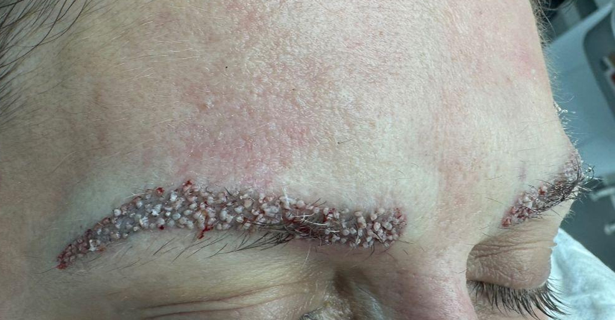 Eyebrow transplant treatment