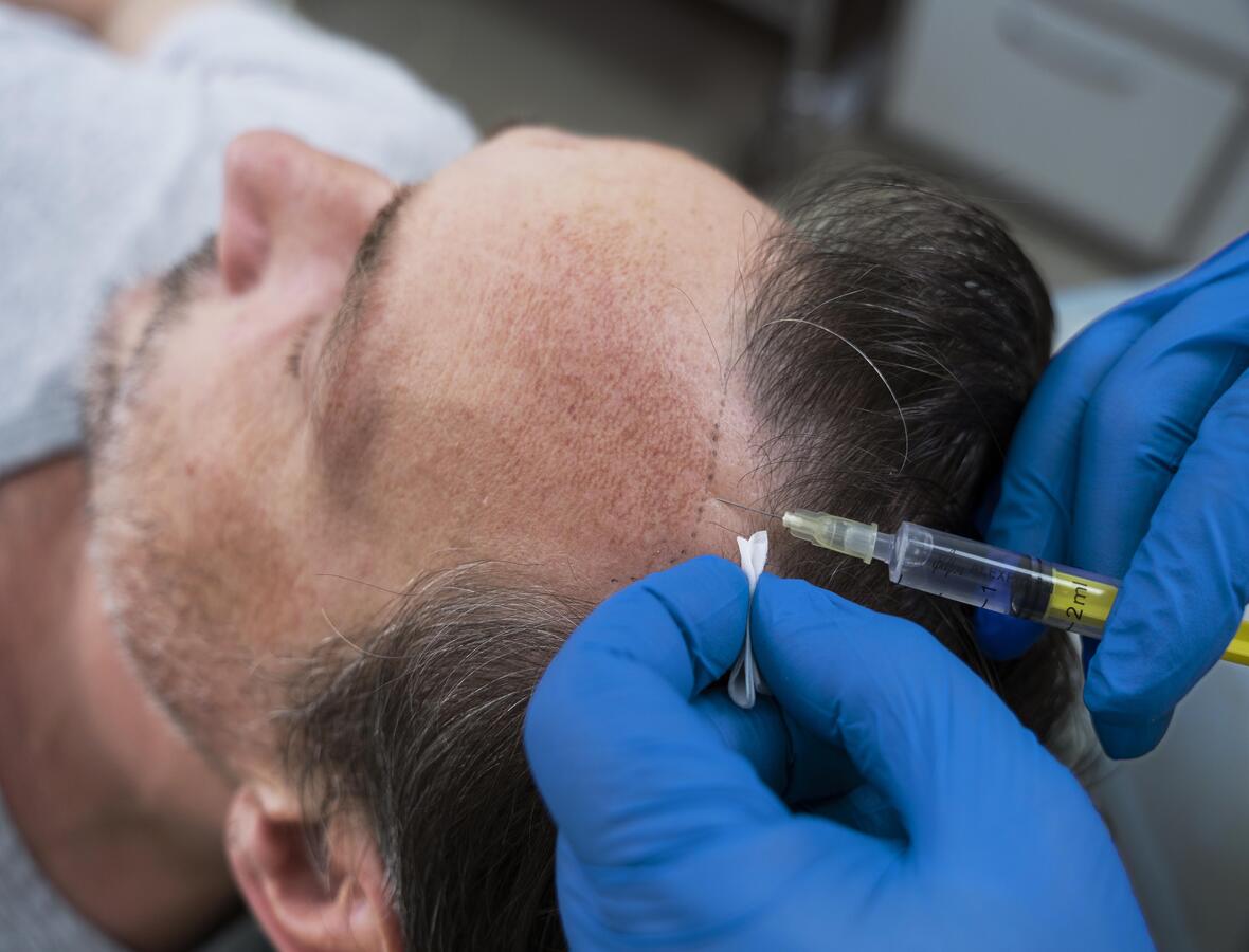 Platelet-rich plasma therapy treatment