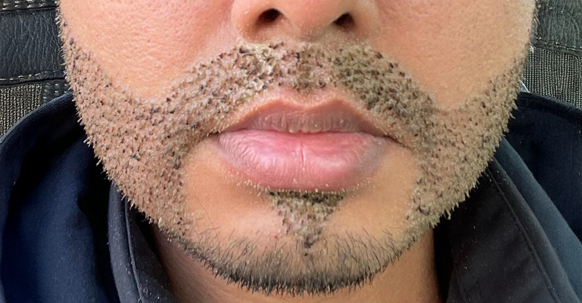 Beard transplant procedure result