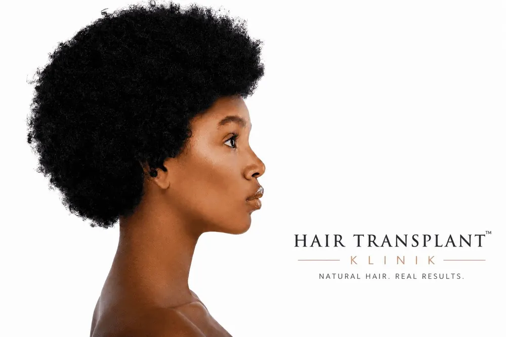 Afro Hair Transplant for Women