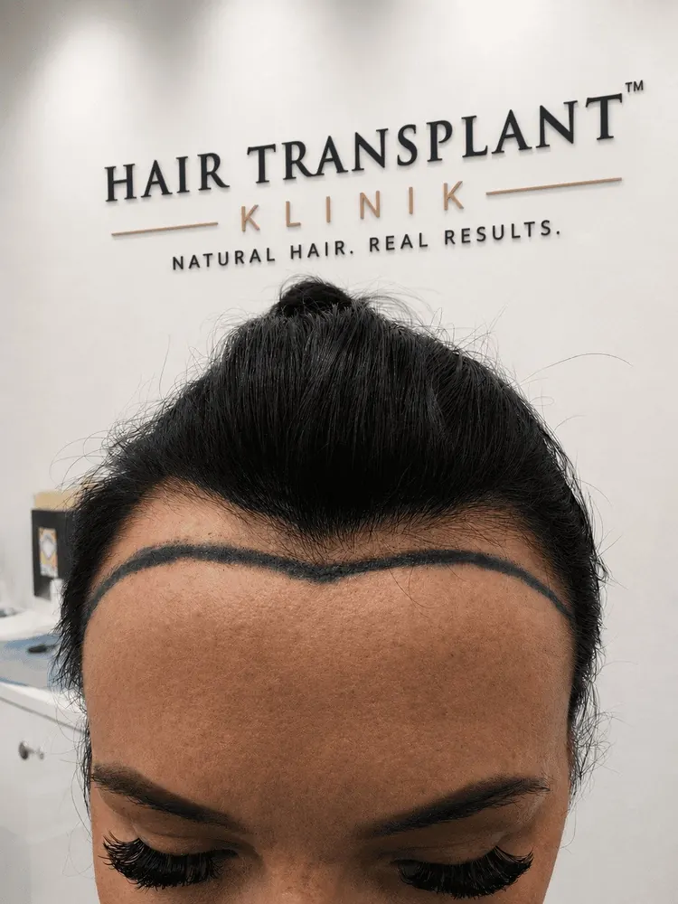 Hair Transplant (FUE) for Women