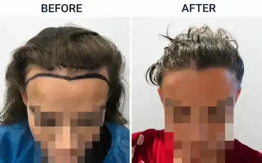 Parting & densityFemale FUE result