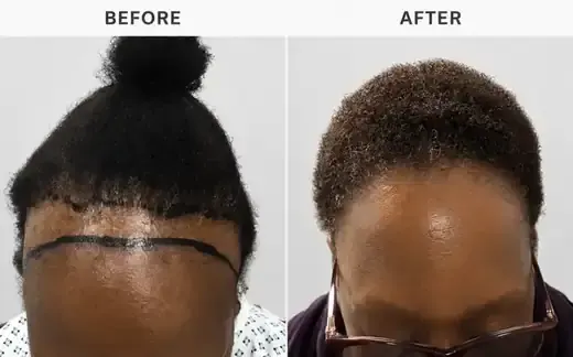 Frontal hairlineFemale FUE result