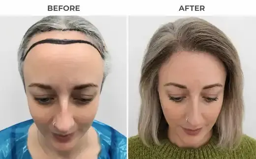 Hairline restorationFemale FUE result
