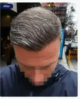 After FUE hairline transplant, restored hairline