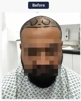 Before hairline reconstruction