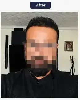 After hairline reconstruction
