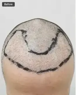 Before hairline design