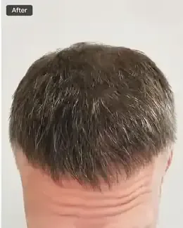 After hairline design
