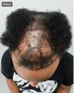 Before crown FUE