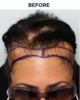 Before female hairline restoration