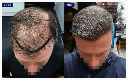 Hair transplant before and after result