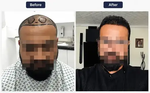 Hair transplant before and after result