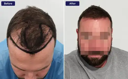 Hairline restoration