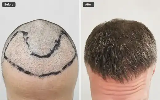 Hair transplant before and after result