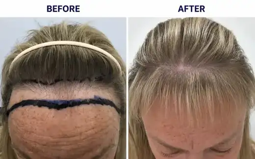 Hair transplant before and after result
