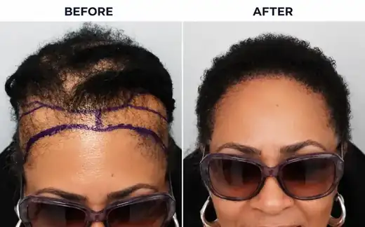 Hair transplant before and after result