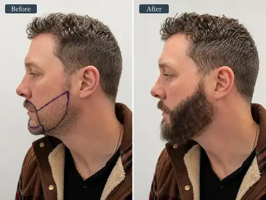 Hair transplant before and after result