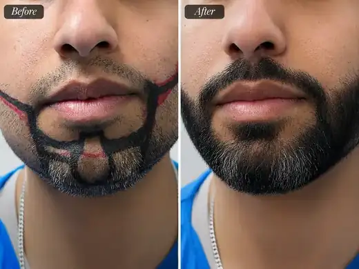 Hair transplant before and after result
