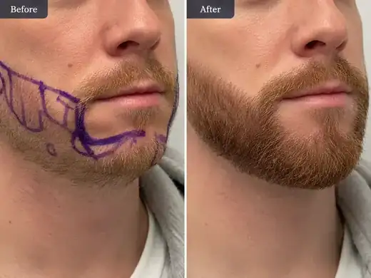 Hair transplant before and after result