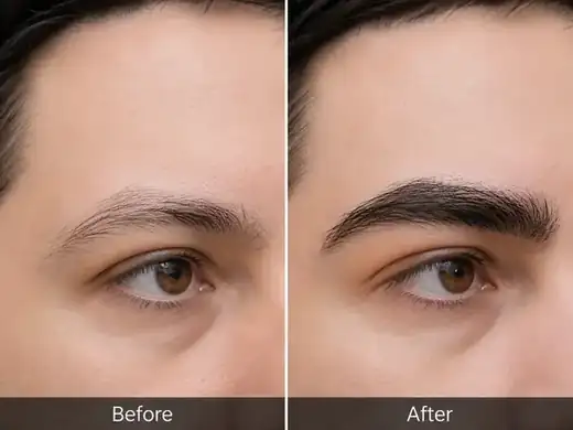 Hair transplant before and after result