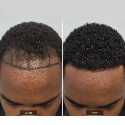 Hair transplant before and after result