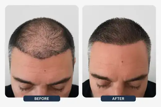 Hair transplant before and after result